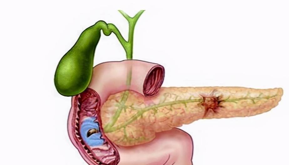 四,感染因素急性胰腺炎可以诱发各种细菌感染和病毒感染,病毒或细菌是