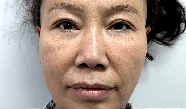 54岁姐姐全面部大拉皮,术后9天的效果_手术_体检_麻醉