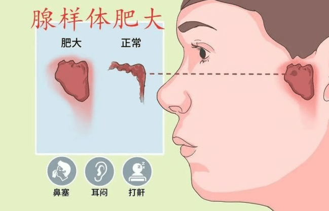 鼻炎,鼻息肉,鼻甲肥大,腺樣體肥大,扁桃體肥大,鼻中隔偏曲等.