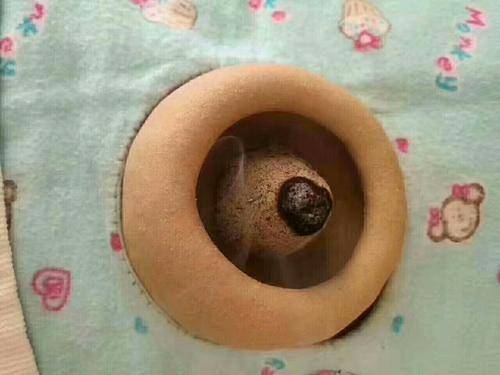 脐灸的注意事项有哪些?_患者_火候_面碗