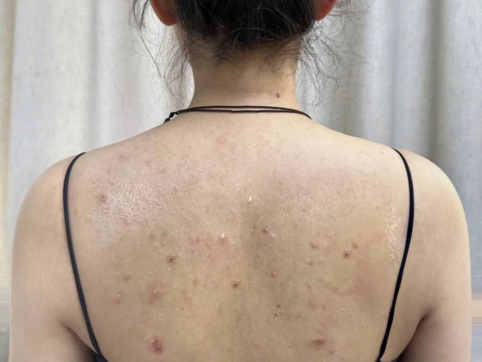 每天只花几毛钱_痘痘_皮肤_后续