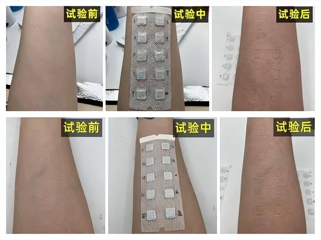 某些产品含有香精,甲基异噻唑啉酮(mit)等易致敏成分,皮肤斑贴试验的