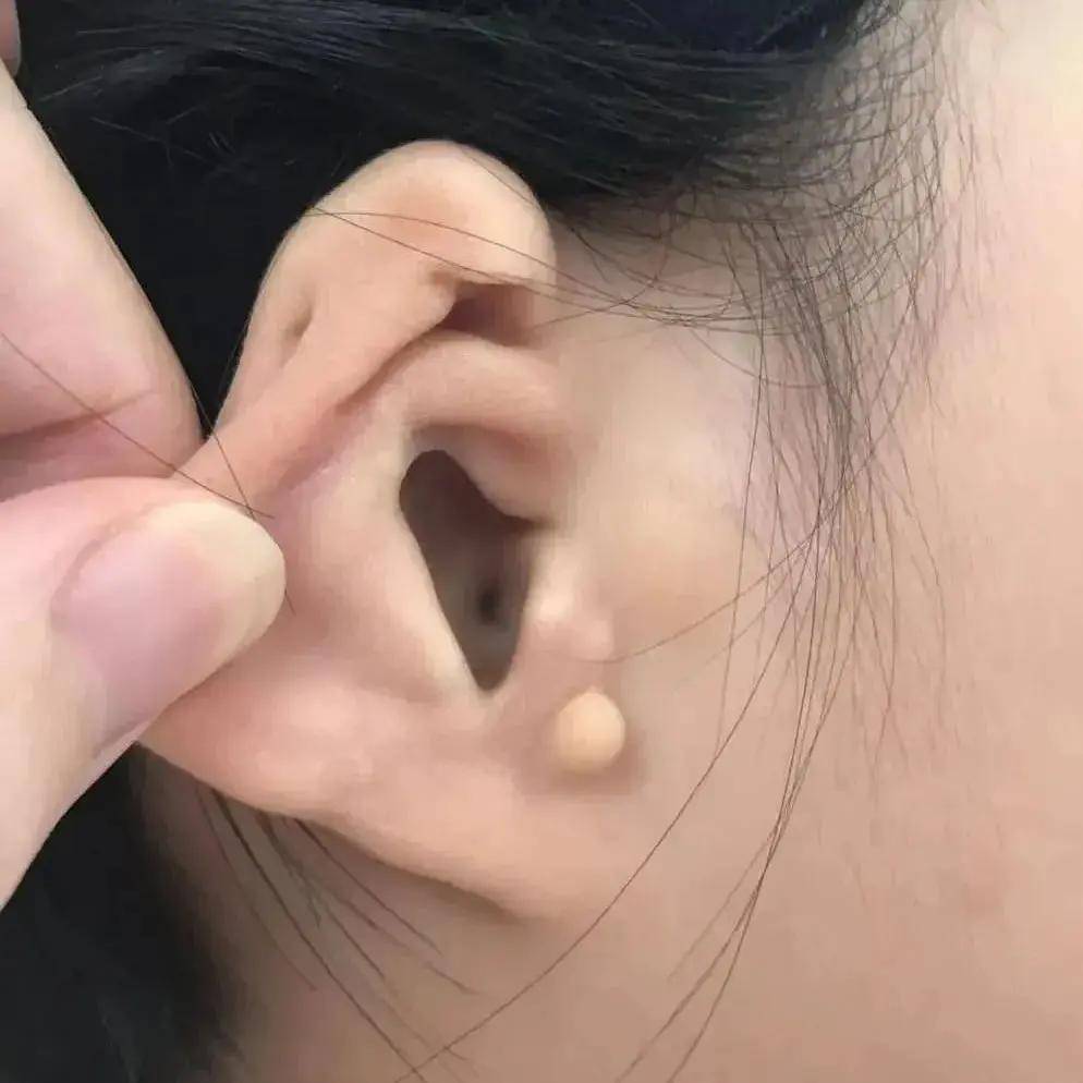 綦江惠耳助听器与您分享:双侧外耳道闭锁听力干预案例分享_进行_小耳