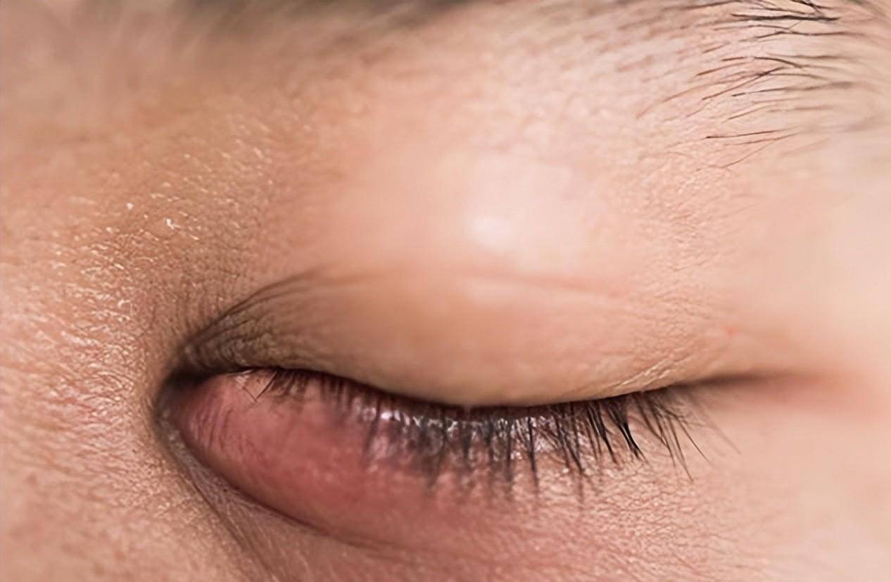 体内有癌,眼睛先知?医生提醒:眼睛出现3种异常,最好检查一下