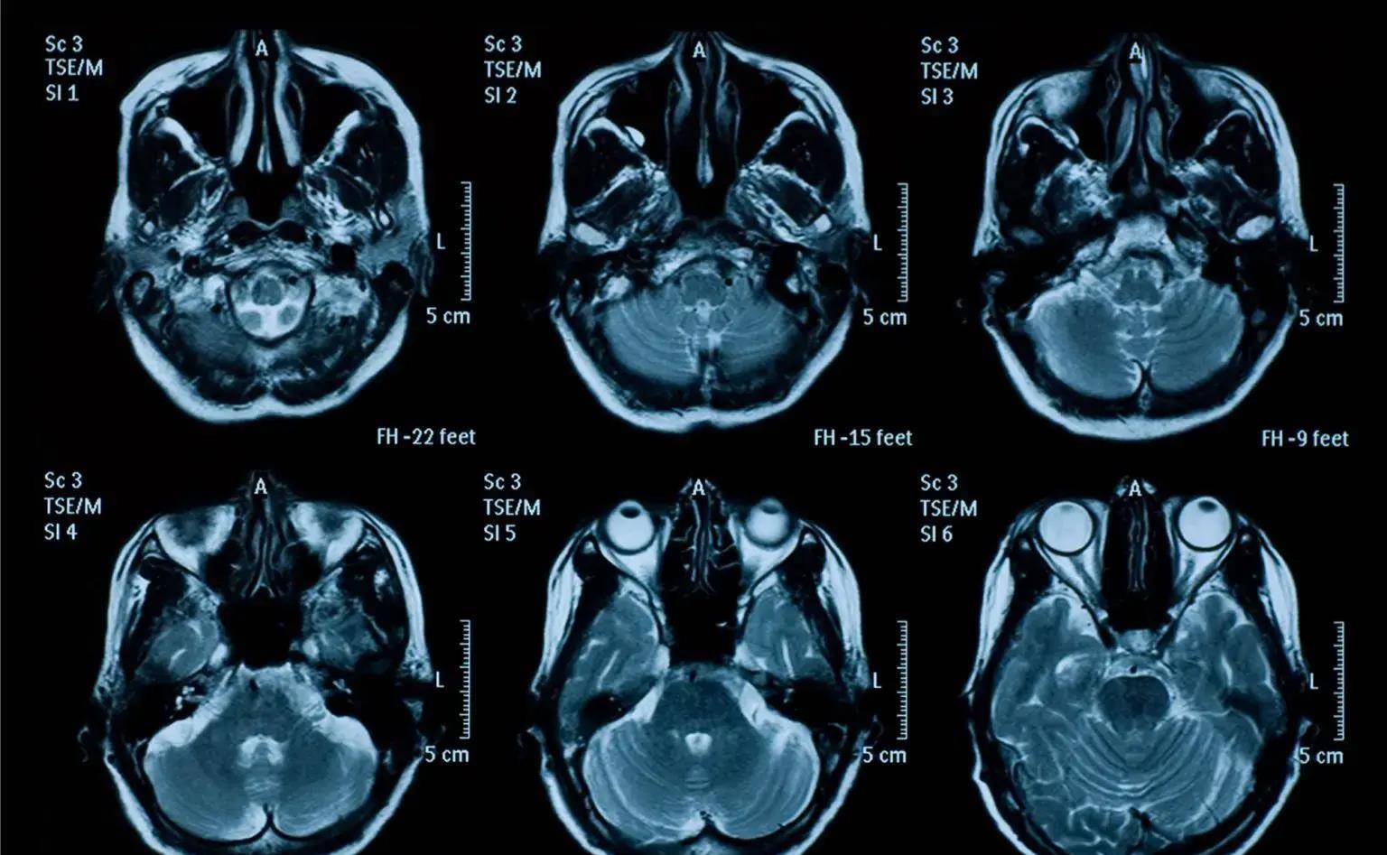 挥之不去的脑损伤症状困扰着脑震荡患者_大脑_扫描_区域