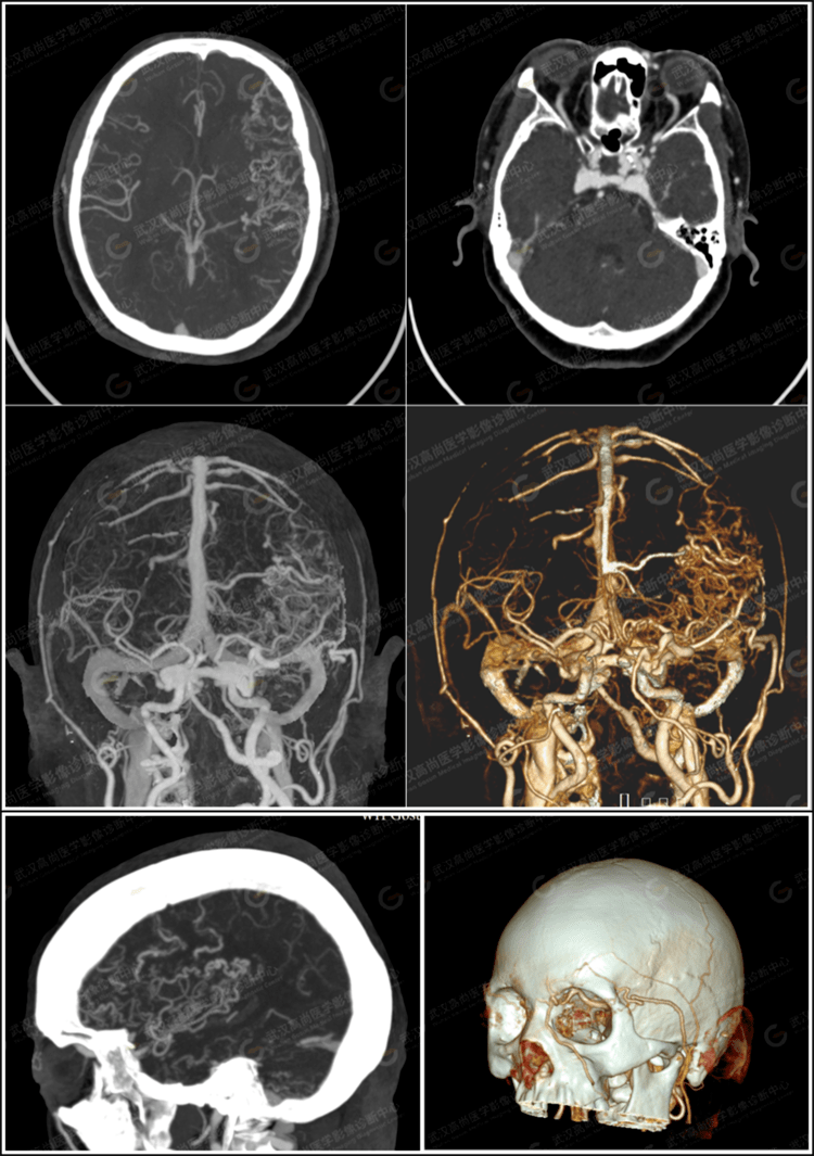 cta诊断硬脑膜动静脉瘘一例