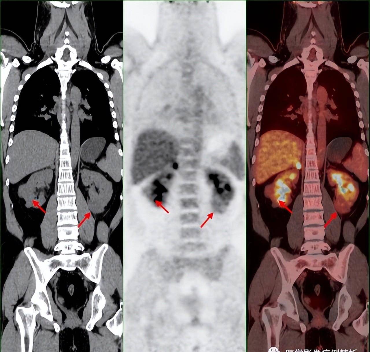 单纯肾病吗?vhl综合征(林岛综合征)pet-ct影像诊断及鉴别诊断