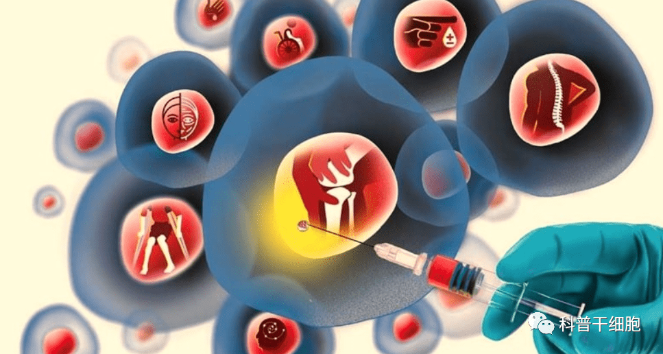 而干细胞治疗就不同,将提纯高纯度,高活性的干细胞扩增后,通过静脉回