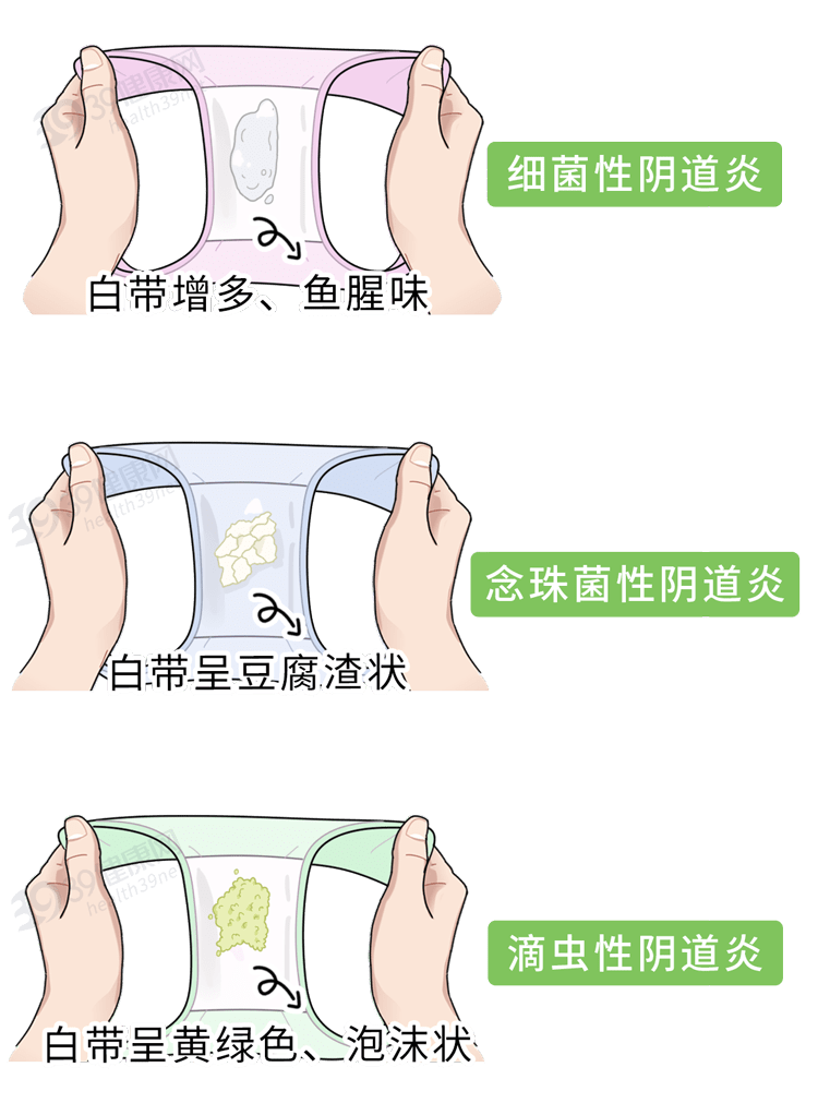 女性分泌物黄黄图片