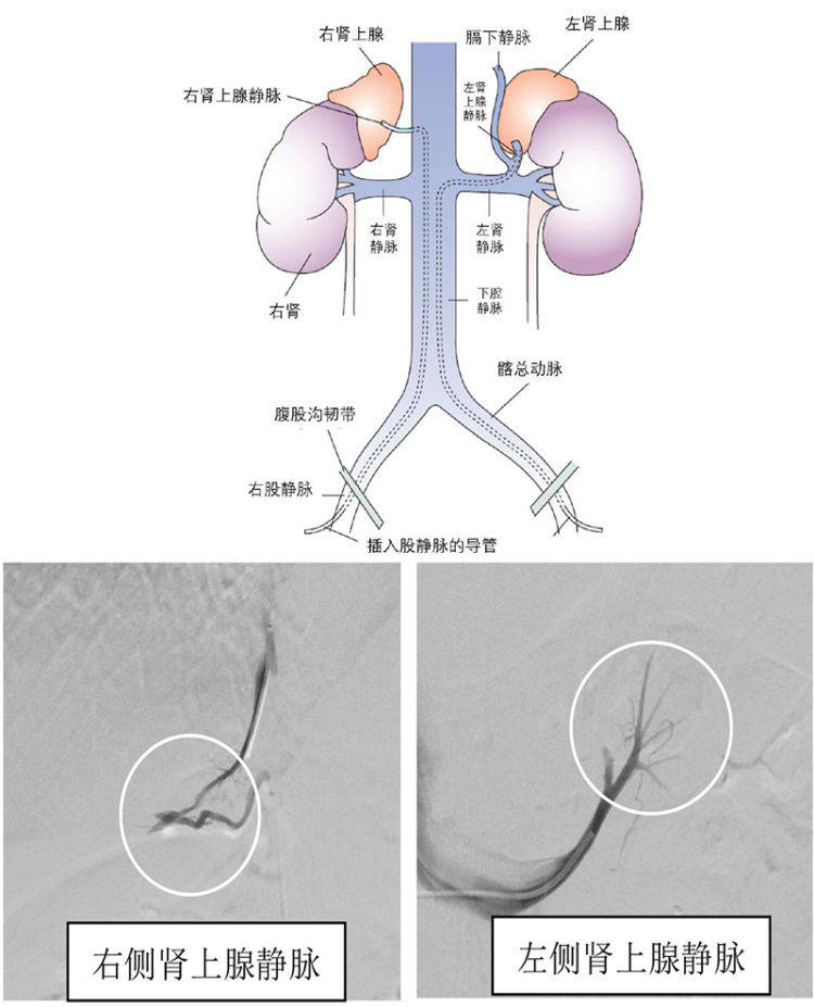 入院后测醛固酮明显升高,ct提示左侧肾上腺结节性增粗,为进一步明确