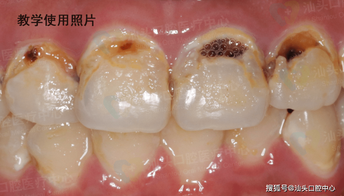 酸蚀症汕头口腔医疗中心医生提醒,若你工作环境经常接触到酸性物质,或