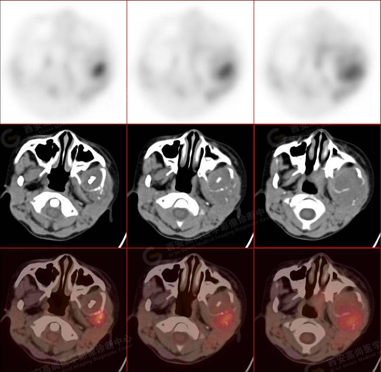 儿童颌面部横纹肌肉瘤1例西安高尚医学影像诊断中心pet/ct病例_肿瘤
