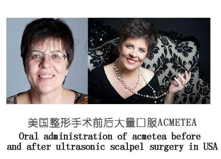 实锤了：筋膜悬吊面部提升术多少钱、筋膜提升多少钱~-筋膜悬吊多久有效果