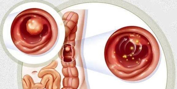 女性肠息肉的早期症状图片