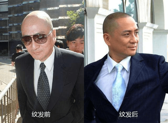 纹发作为新出现的技术,对于长期脱发严重,已经秃顶