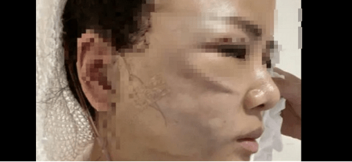 再问：面部筋膜提升术能保持多久？面部筋膜悬吊的术后恢复做的咋样？-筋膜悬吊术面部凹陷坑图片