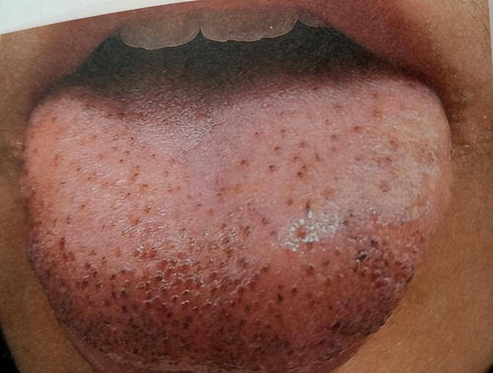 舌头有瘀斑,舌下青筋又粗又黑,是哪里出了问题?