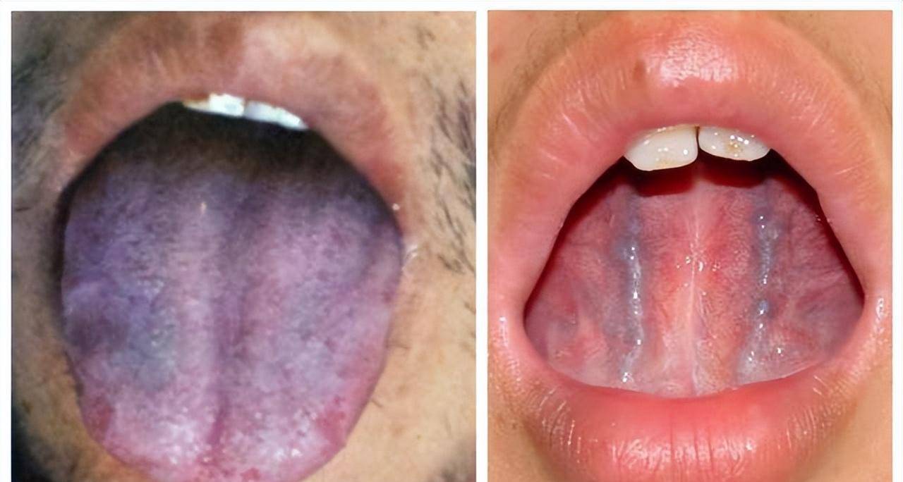 舌头有瘀斑,舌下青筋又粗又黑,是哪里出了问题?