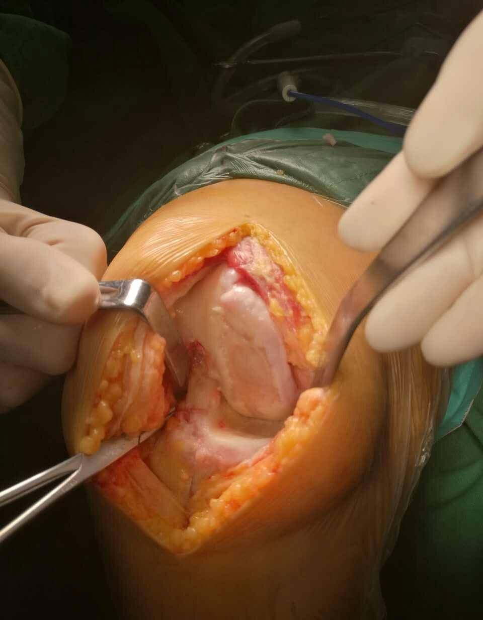 人工关节置换术可以还髋膝关节疾病患者健康?