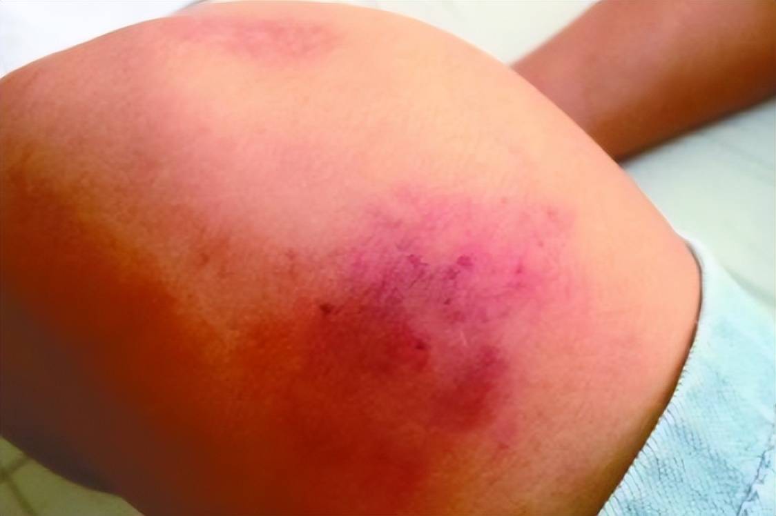 轻伤二级是如何判定的?_影响_情况_受伤