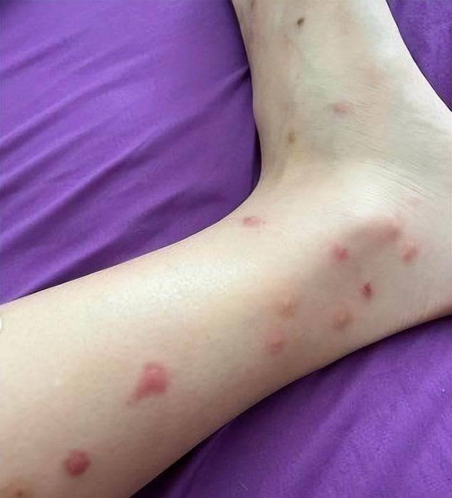 朱智贤在贴出双脚被木虱咬到满是红点的照片朱智贤脸上布满红点,密集