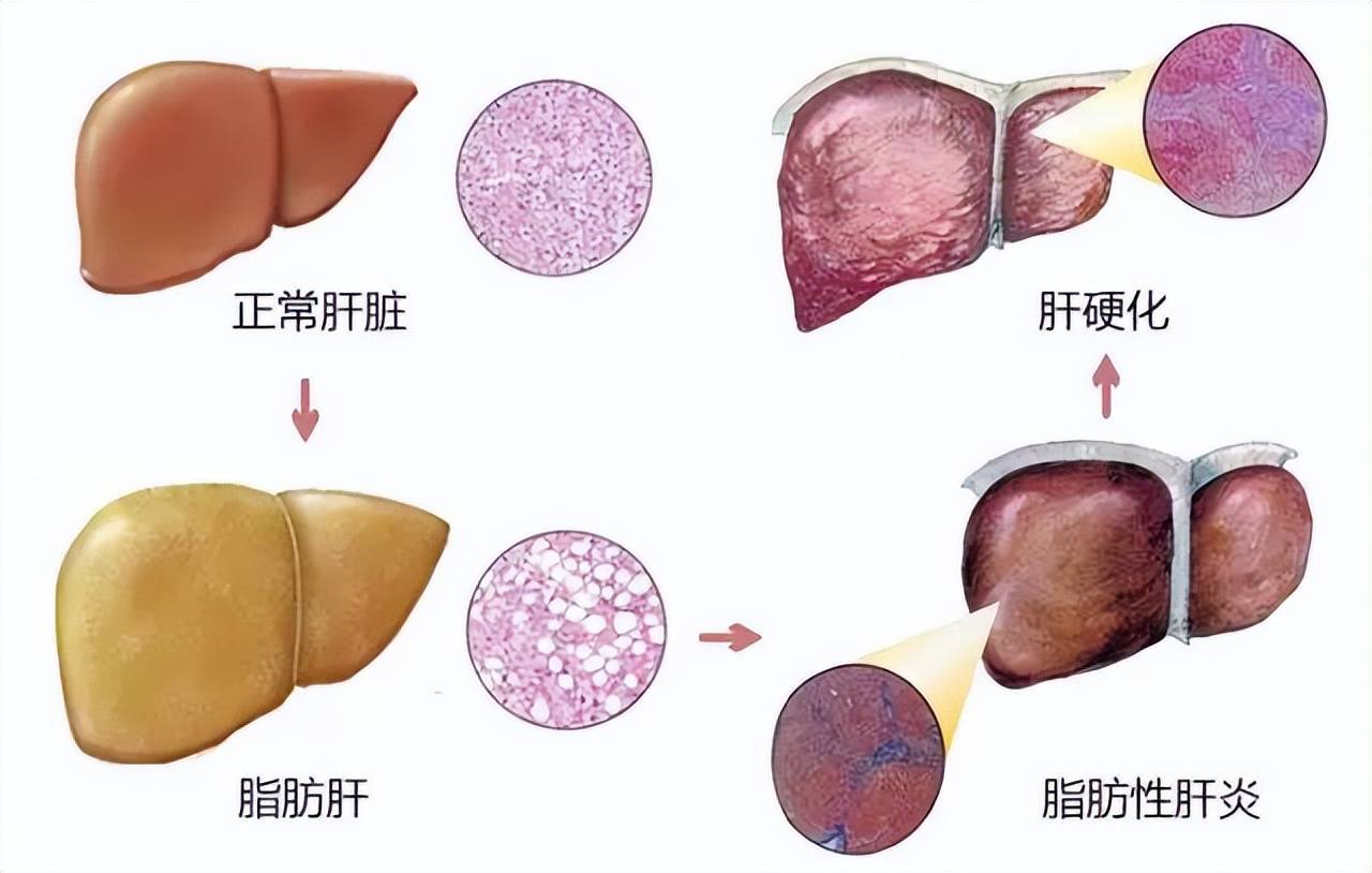 我们通常说的脂肪肝轻重指的是肝细胞脂肪变性的比例:肝细胞脂肪变性