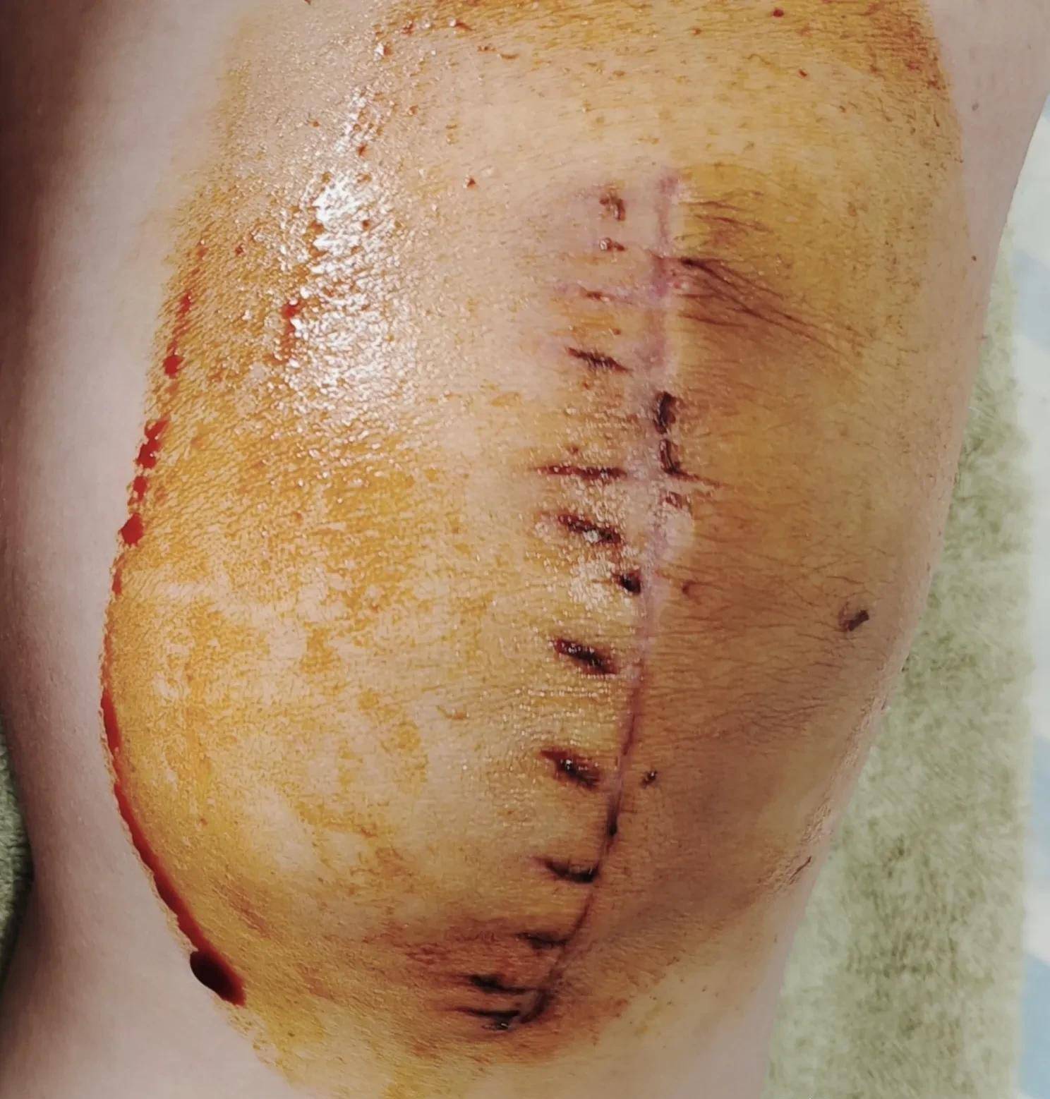 髌骨骨折术后第25天,伤口暴露以后加了针灸,推了疤痕