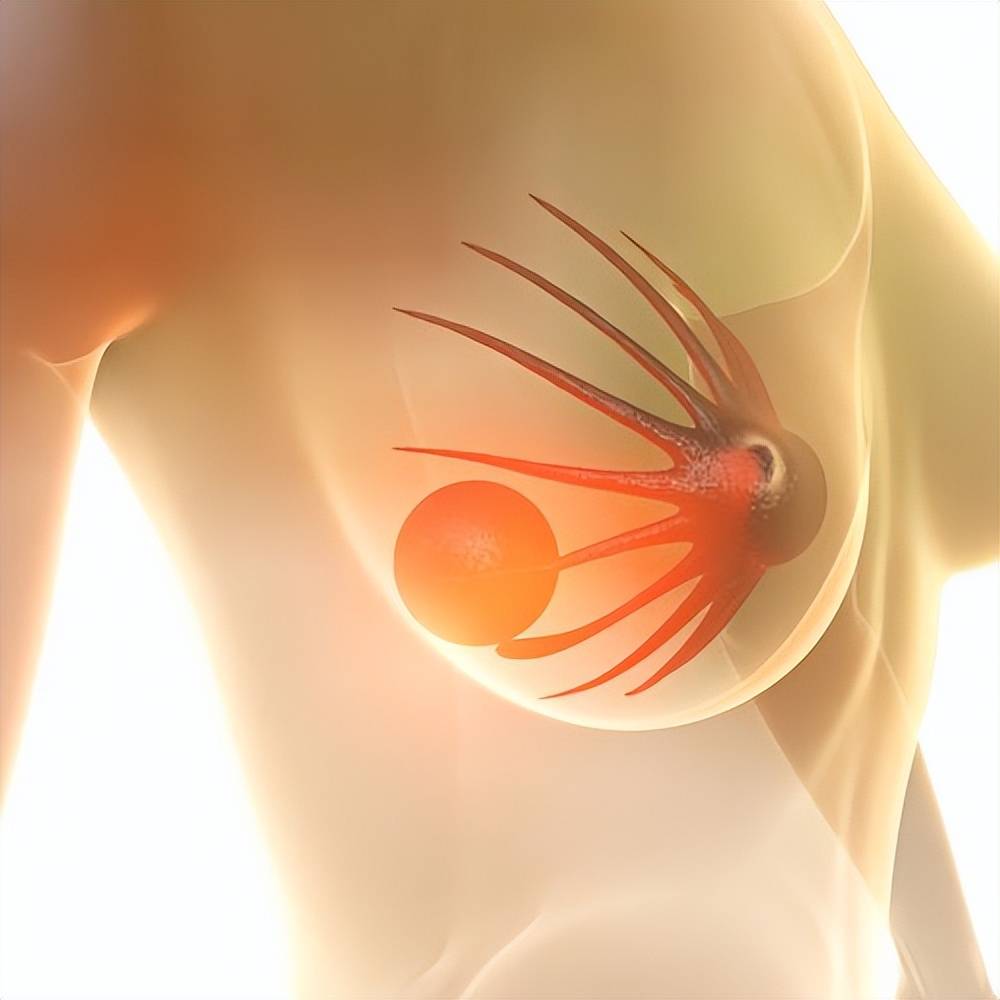 乳腺增生、乳腺结节和乳腺囊肿的区别