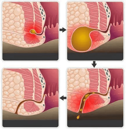 肛周脓肿窦道形成图片图片