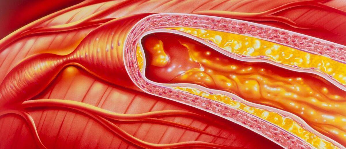 摸摸手脚的动脉,如果出现1个表现,或是动脉堵了_生活_人群_血管
