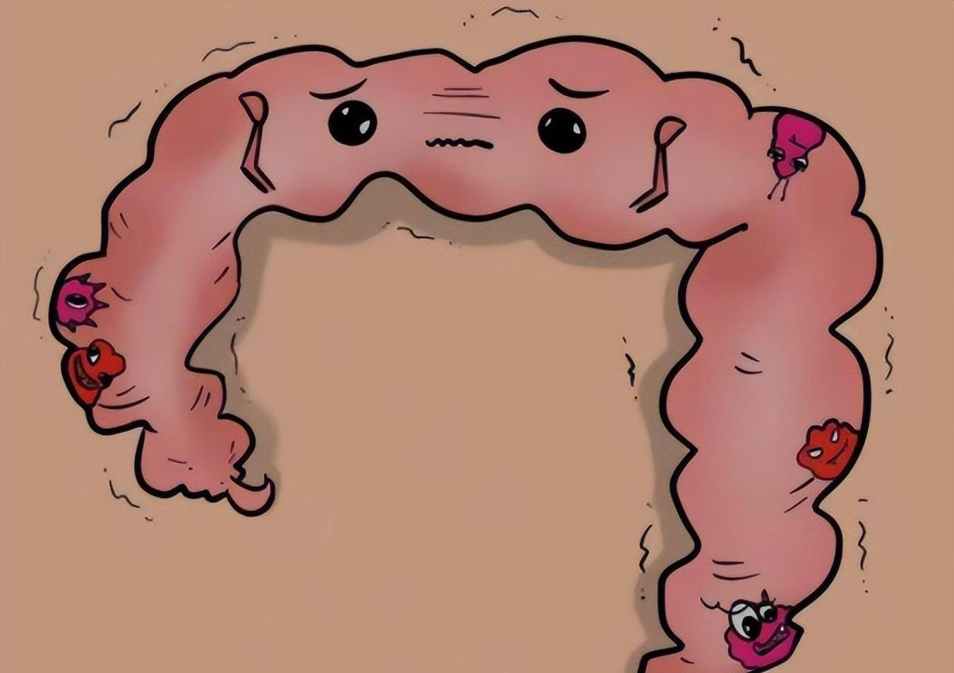 肠癌的大便图 粘液图片
