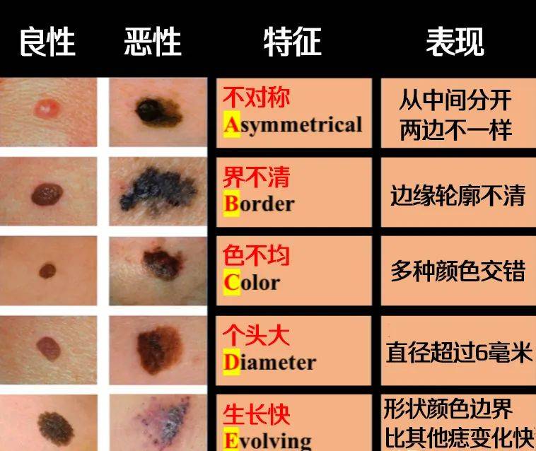 约1/4的由黑痣所引起的黑色素瘤,在恶变前曾接受过不恰当的治疗,如过