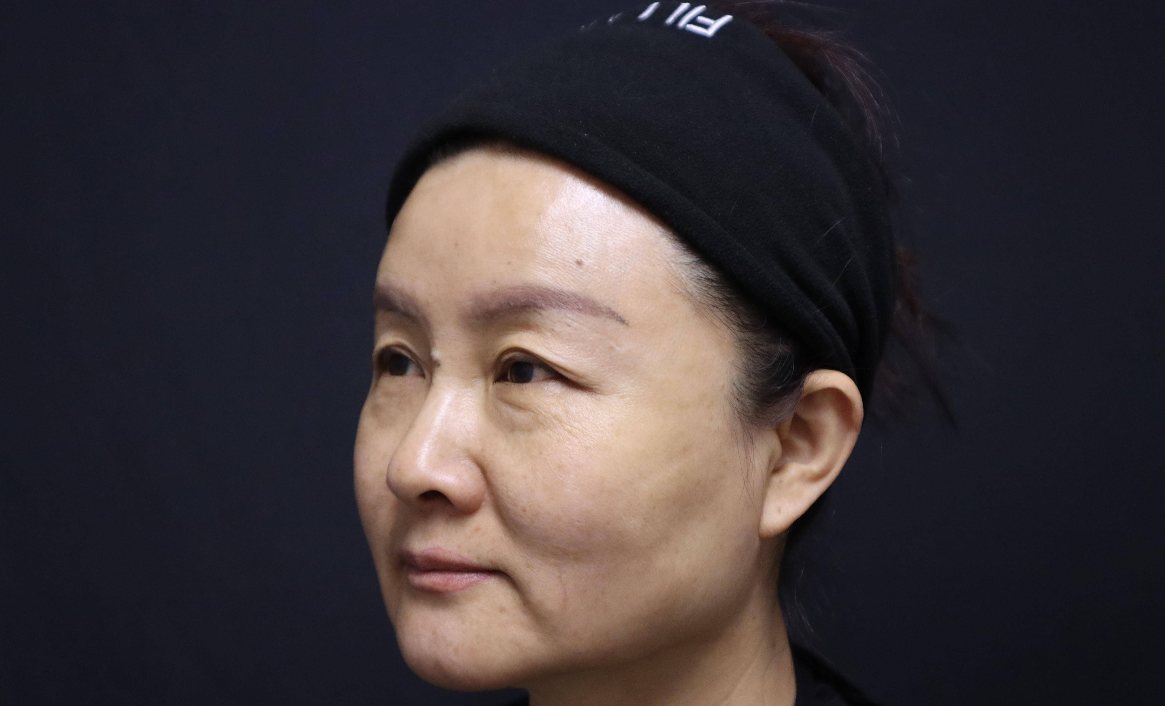 50岁眼周松弛下垂,三角眼,提眉手术让我在亲家面前重获自信_眼睛_额头