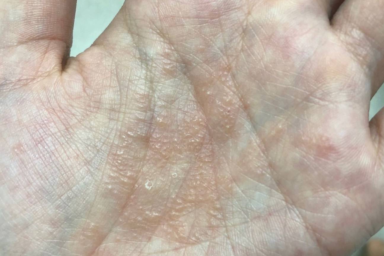 手心长了很多小水泡小心是汗疱疹!_体质_代谢_皮肤