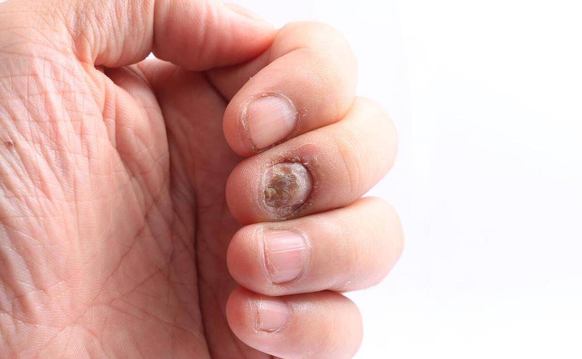体内有癌,手指先知?