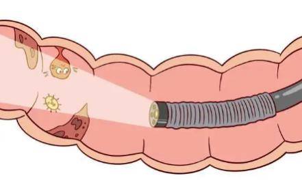 肠息肉的自白书!_检查_家族_人类