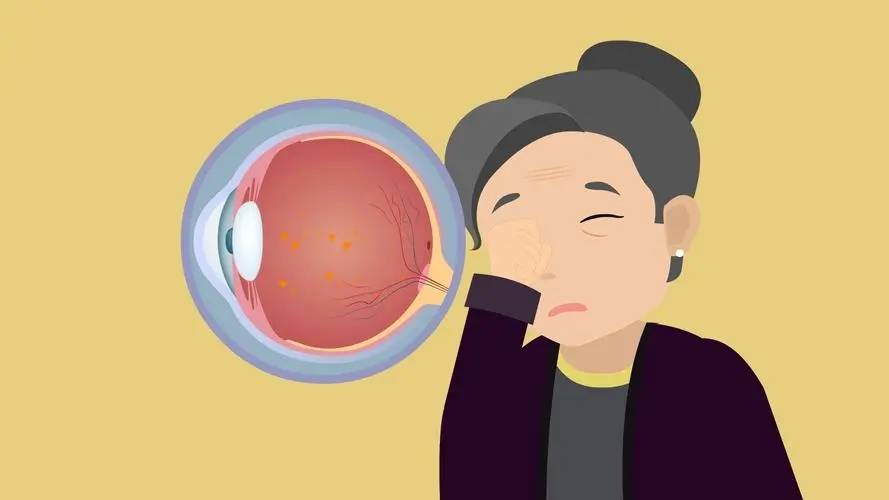 病理性飞蚊症:一般由眼底病理性改变引起,如视网膜裂孔,脱离,玻璃体