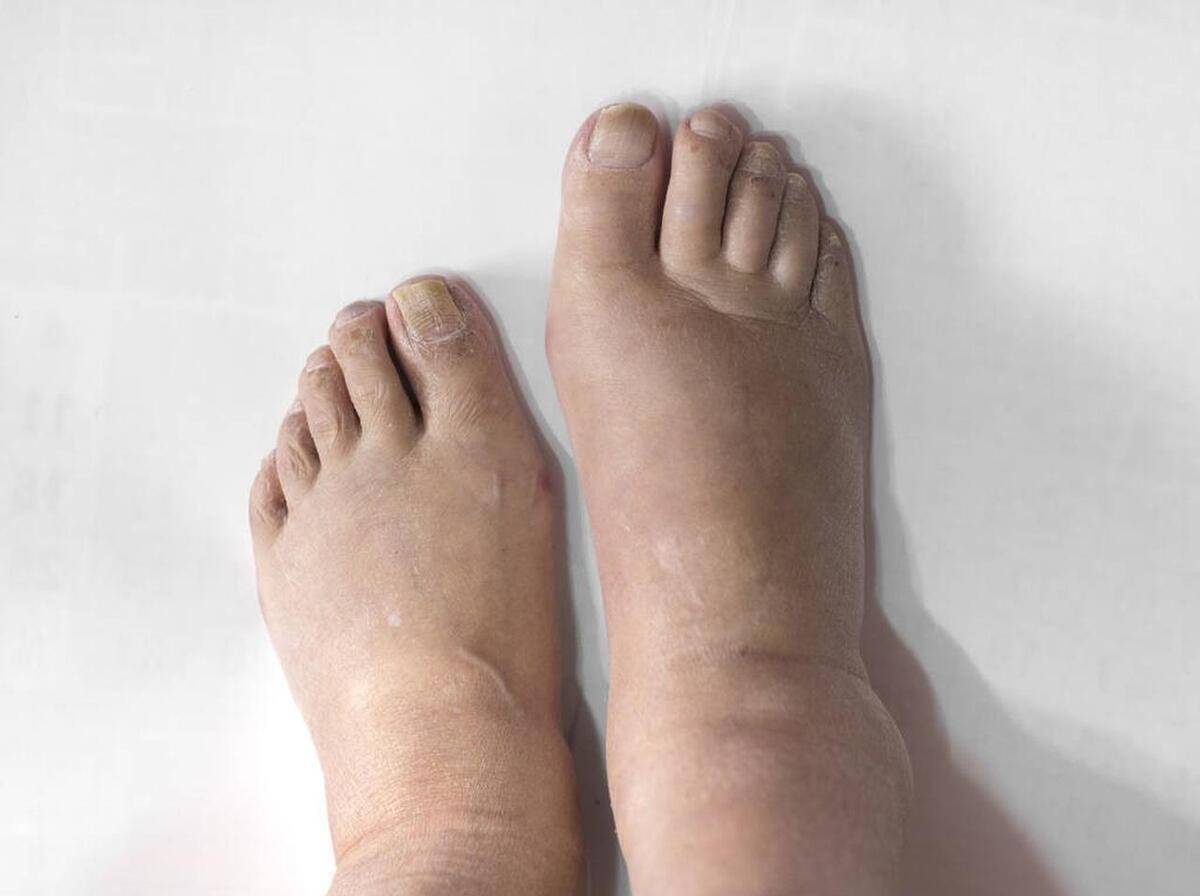 慢阻肺患者脚肿腿肿是什么原因?