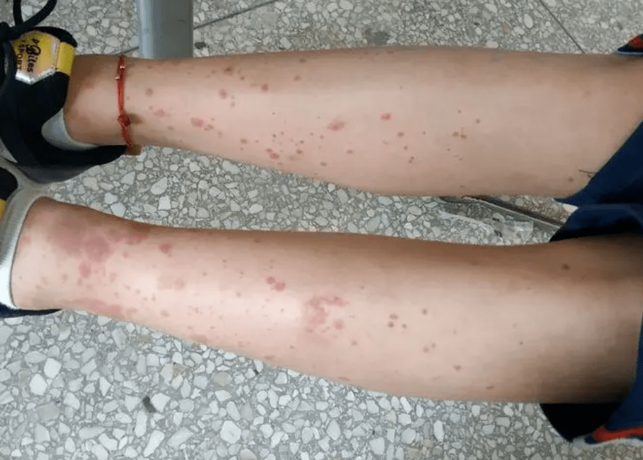 过敏性紫癜伤"身"又伤"钱",久治不愈给紫癜患者带来哪些影响?