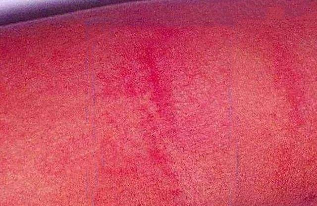 猩红热是什么病猩红热症状竟有这么多_孩子_身体_皮肤