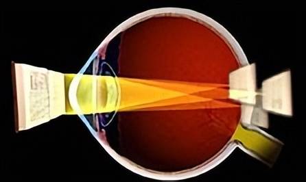 较高度数的散光(超过200度),甚至可导致儿童发生弱视,这部分患者的