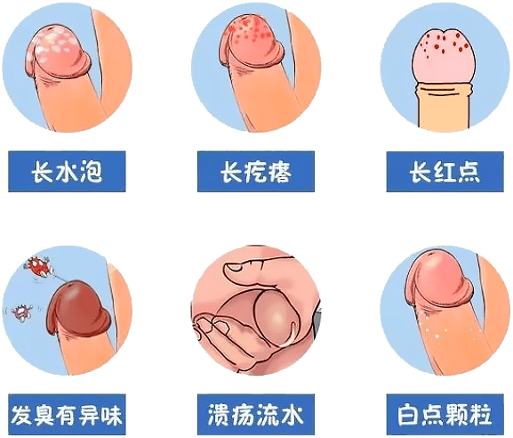 龟头部位是否有发生糜烂及浅小溃疡,并有黄色脓性或乳白色臭味分泌物