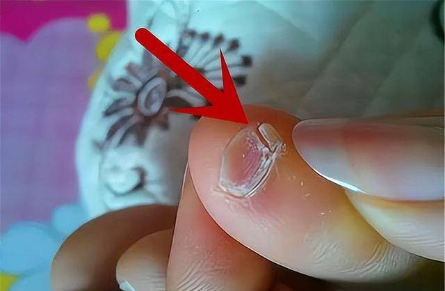 由于后来鲜卑人逐渐与汉族结合,汉族人群中瓣状甲的人越来越多,因此在