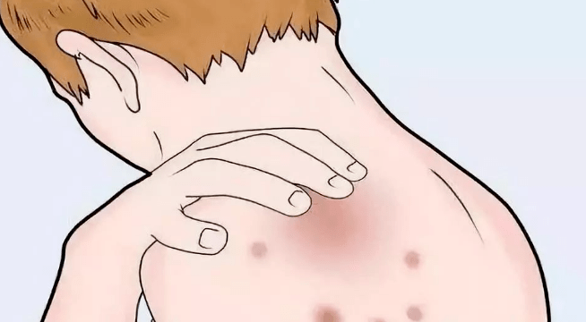 过来人给你支几招,红肿瘙痒的症状秒没!_皮肤_药膏_控制