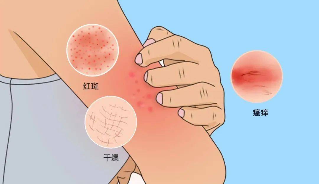 皮肤病患者,长期吹空调会引起哪些皮肤问题?_细菌_水分_空气