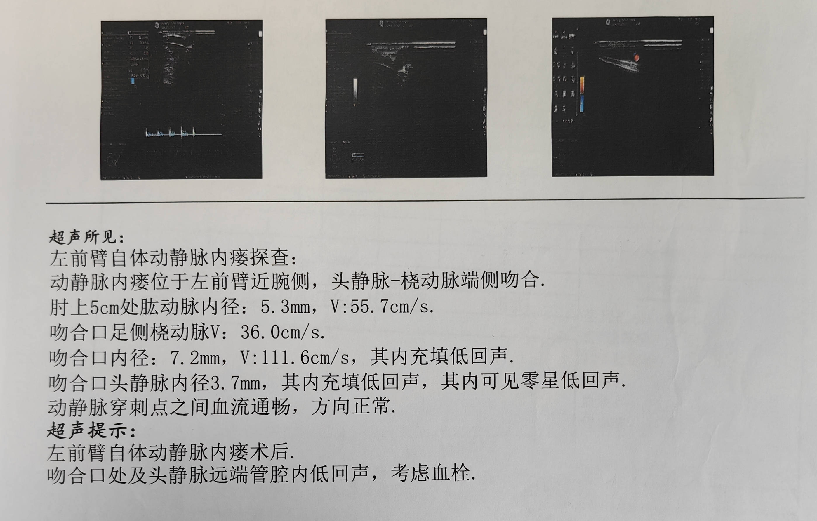 经过查体,医生发现他的左上肢动静脉瘘口处搏动消失