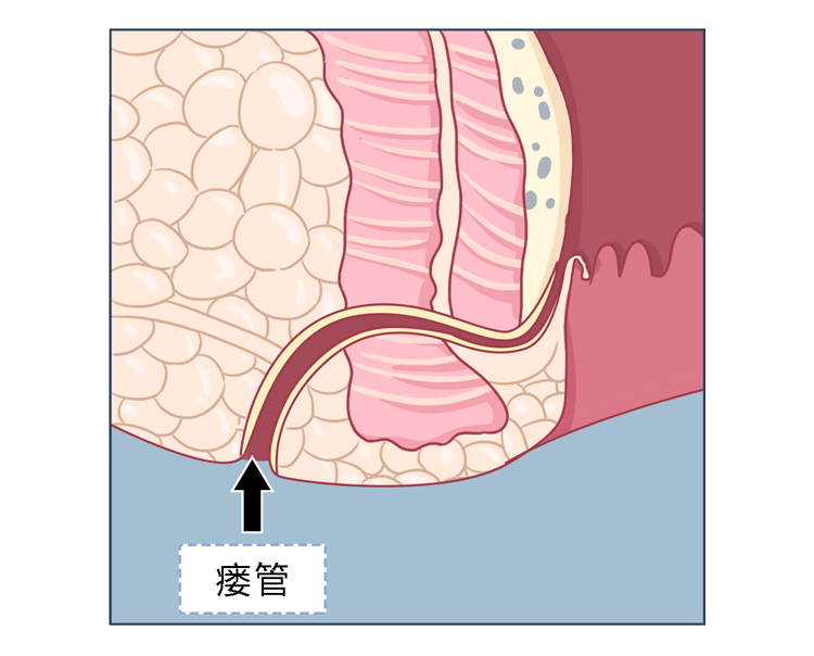 肛瘘初期症状图片