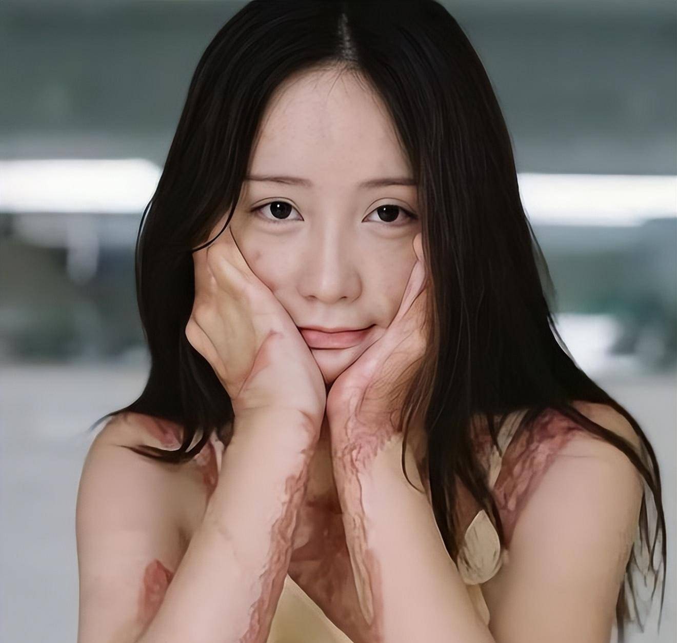 周岩被烧伤后1995年9月9日,周岩出生在安徽省合肥市肥西县撮镇的一个