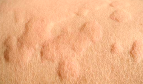 荨麻疹有靠谱的偏方吗？夏天患荨麻疹、湿疹、汗疱疹该怎么办？-荨麻疹最快的偏方大全