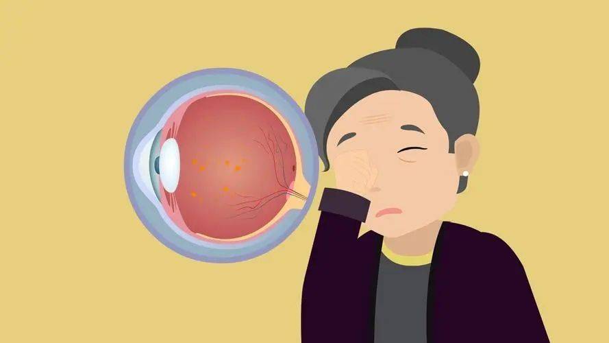 特别是糖尿病患者,血糖容易升高,稍有忽视就会引发糖尿病视网膜病变